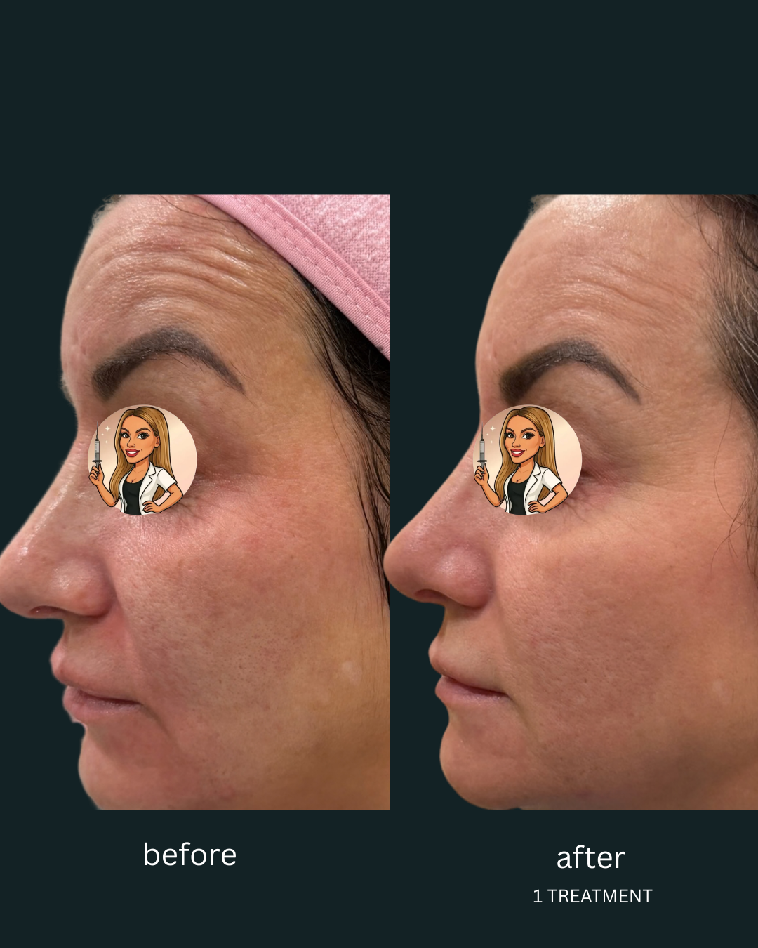 NOUVADerm laser treatment right profile before and after showing smoother skin texture, softened fine lines, and improved skin tone after one treatment at The Boujee Blonde Aesthetics in Slidell Louisiana