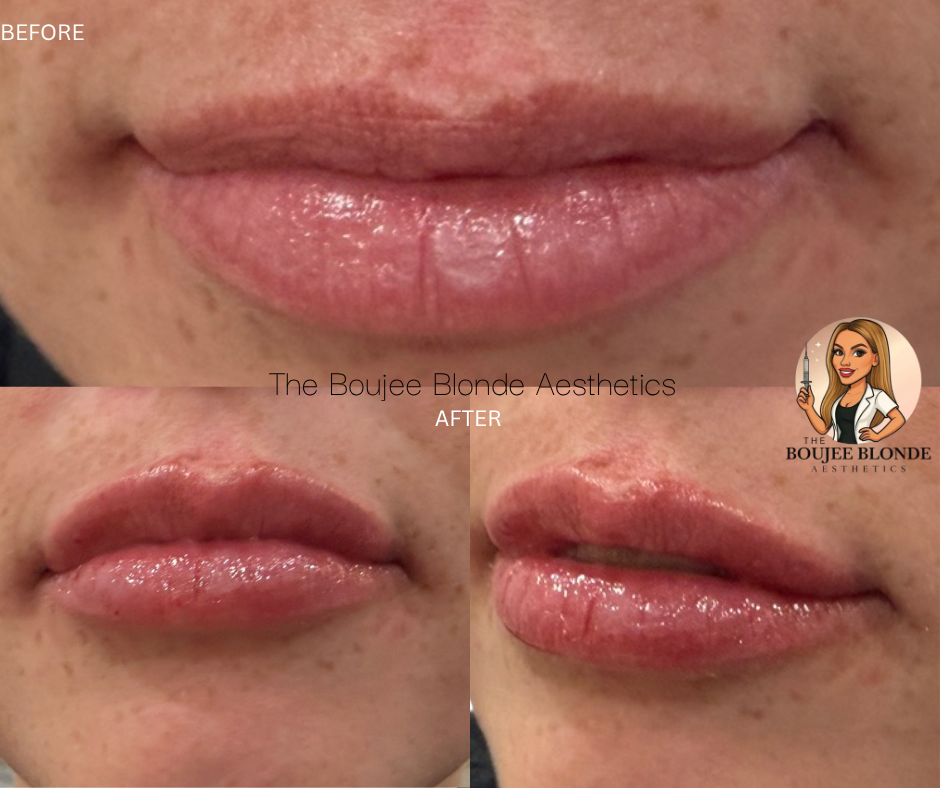 Before and after lip filler results at Boujee Blonde Aesthetics in Slidell Louisiana highlighting improved lip symmetry hydrated texture and natural volume enhancement tailored to the client’s facial features