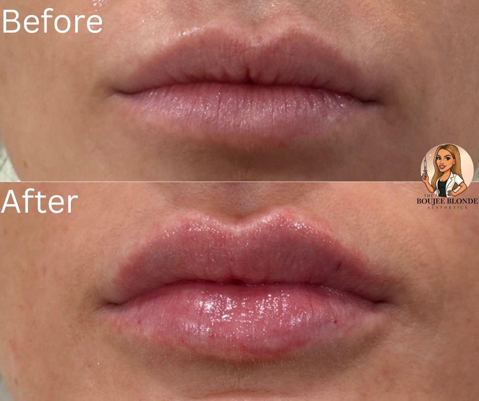 comparison of lips before and after cosmetic lip enhancement, showing increased volume and glossiness in the after image at the boujee blonde medspa in slidell