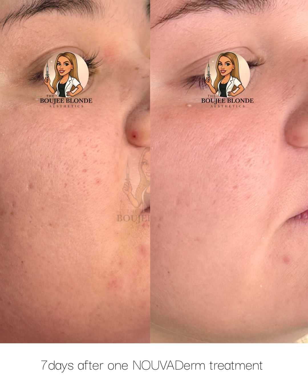 Comparison of skin condition before and after 7 days of NOVUDerm treatment, showing improved skin texture and reduced redness on a person's face.
