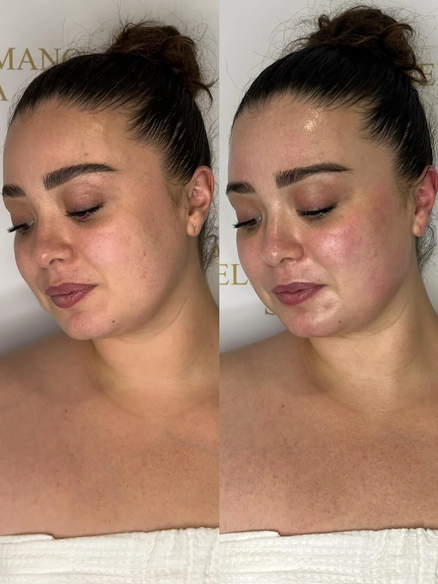 It isn't confirmed yet but...

If you book your appointment, Hydrafacial will give you glowing skin in the new year ✨

#hydrafacial #holidayfacial #winterskincare