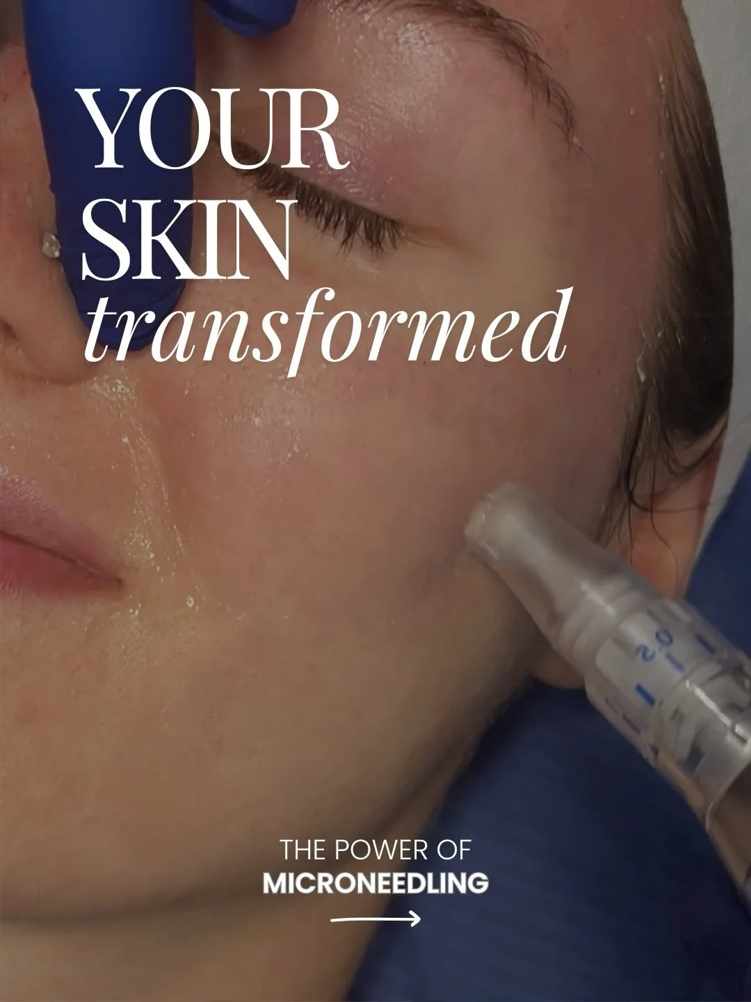 Wondering if microneedling is right for your skin? 

CALL 781-224-0800 or TEXT 781-462-7444 to schedule a consultation! 

#bostonspa #microneedling #skincare