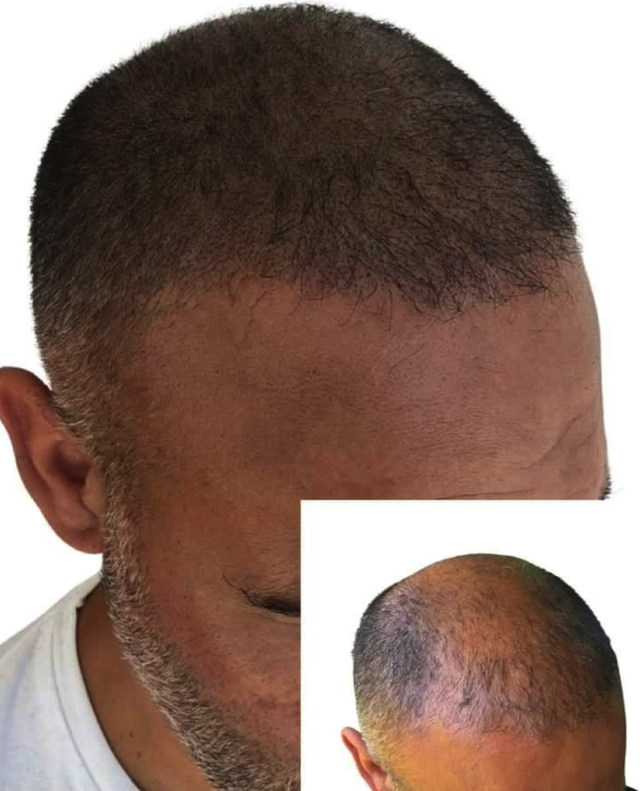 scalp microblading 6.png