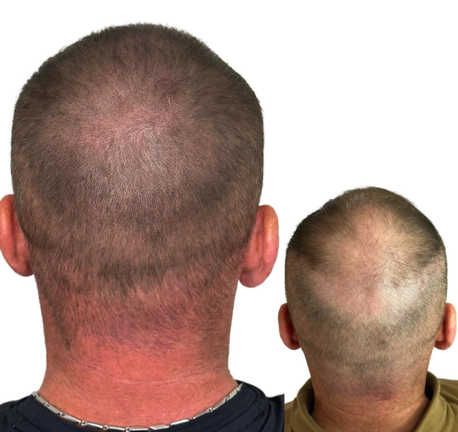 scalp microblading 5.png