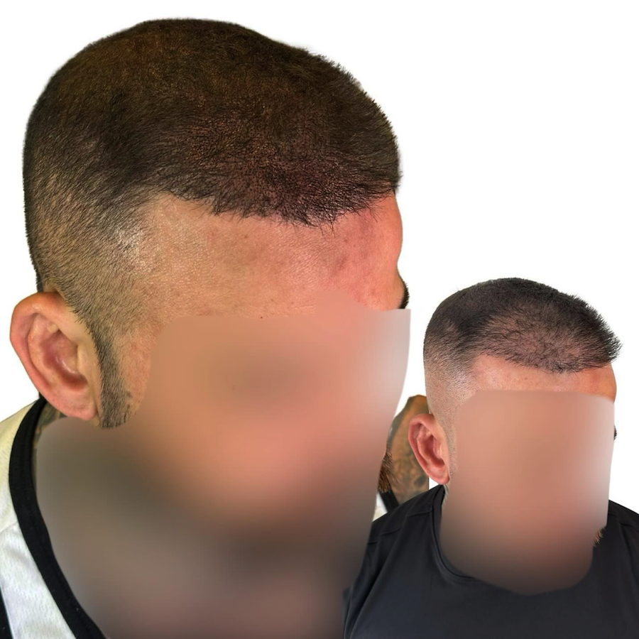 scalp microblading 1.png