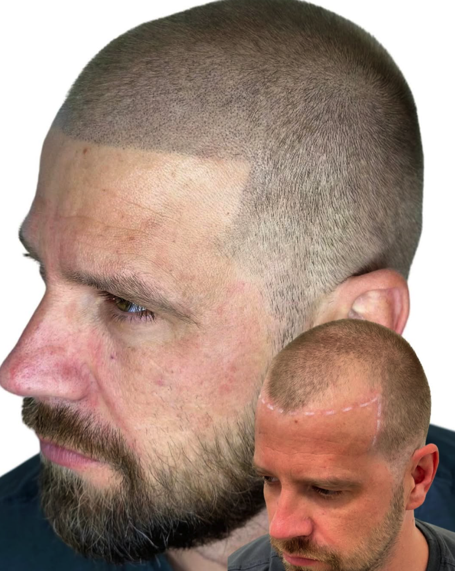 scalp microblading 3.png