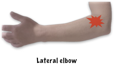 Lateral Elbow Pain (part 1)