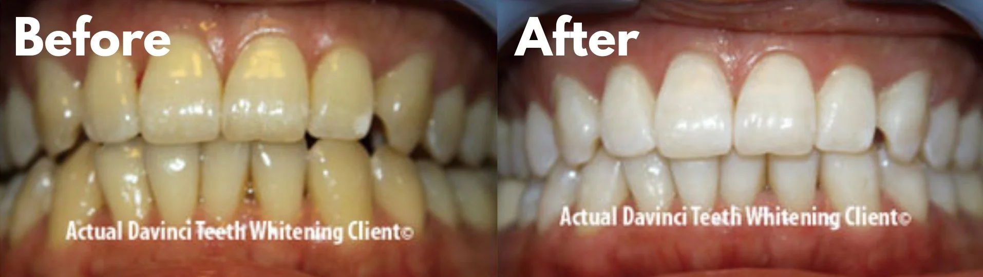 Why Beauty Pros and Dentists Choose DaVinci Teeth Whitening