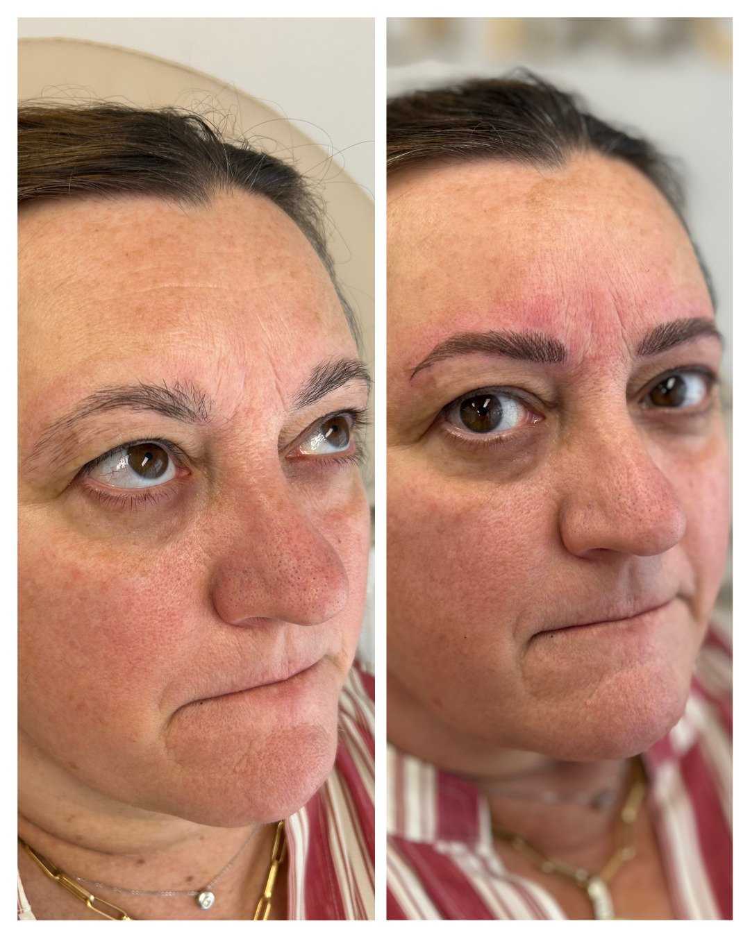 Nano machine hair strokes are used to restore definition and fullness to the brow area. As we age, natural brow hair growth tends to decrease. We can create soft, natural-looking strokes to revitalise the appearance of your brows to their former stat