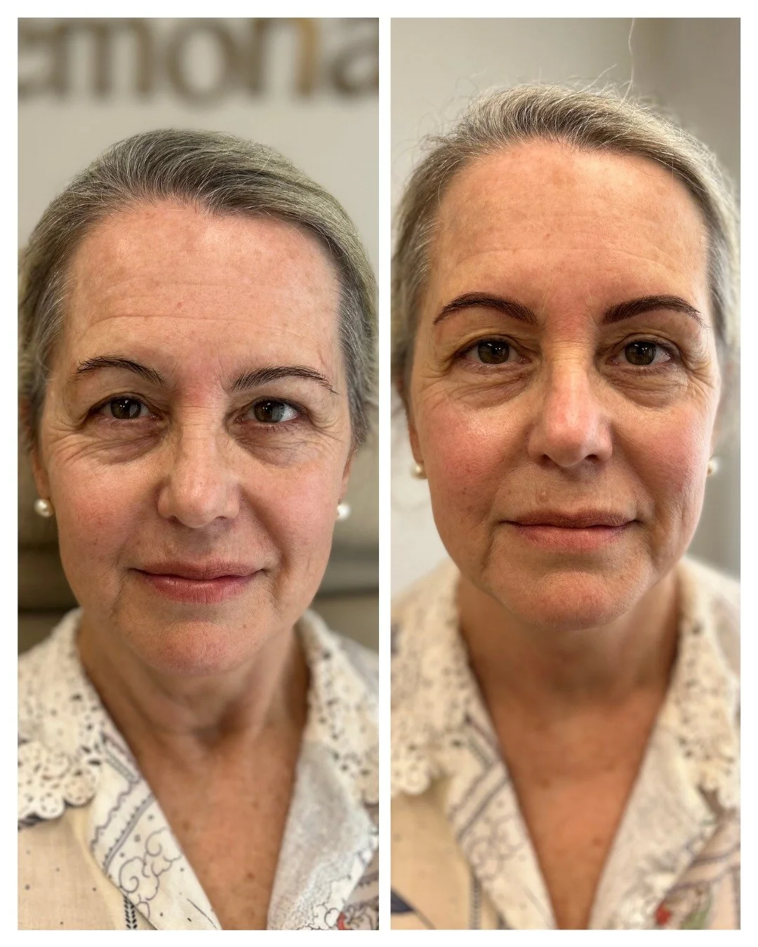 Adding some symmetry back to the brows and making them slightly thicker. I tend to go a shade darker than you want them, as when they heal, the colour softens significantly.