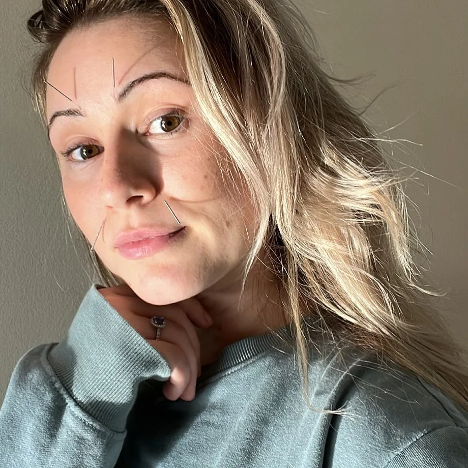A selfie of a self-treatment for immune system support &amp; sinus congestion relief 🪄✨ acupuncture has immunomodulatory actions - meaning that it can help keep our immune system strong to fight off illness, but it can also support in calming the im