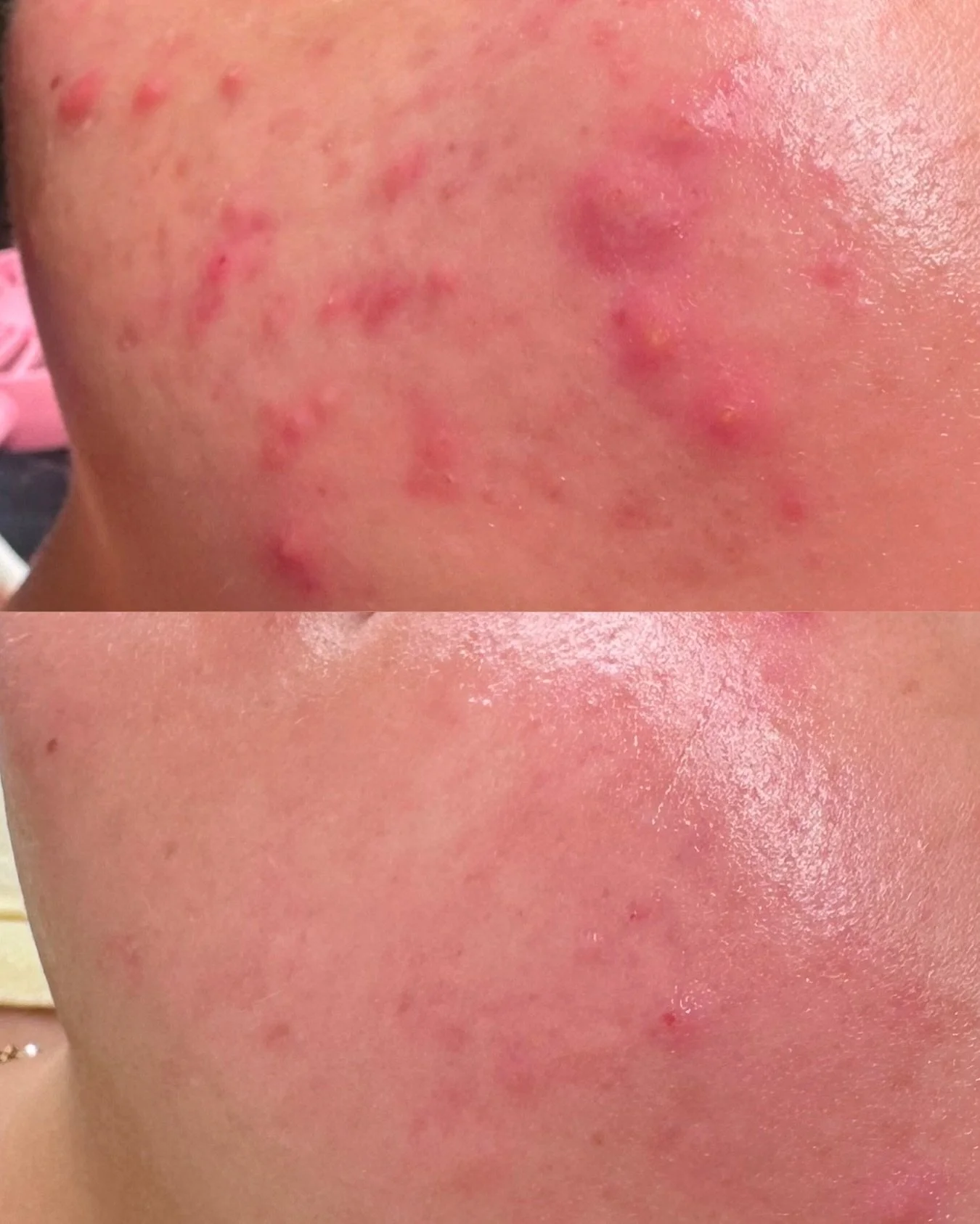 Acne &amp; Inflammation Management 🧖🏻&zwj;♀️

This beautiful client&rsquo;s results are after 2 BioRePeel treatments spaced 7 days apart, combined with a supportive homecare regimen.

🔬 With acne, the first priority is reducing inflammation. By ca