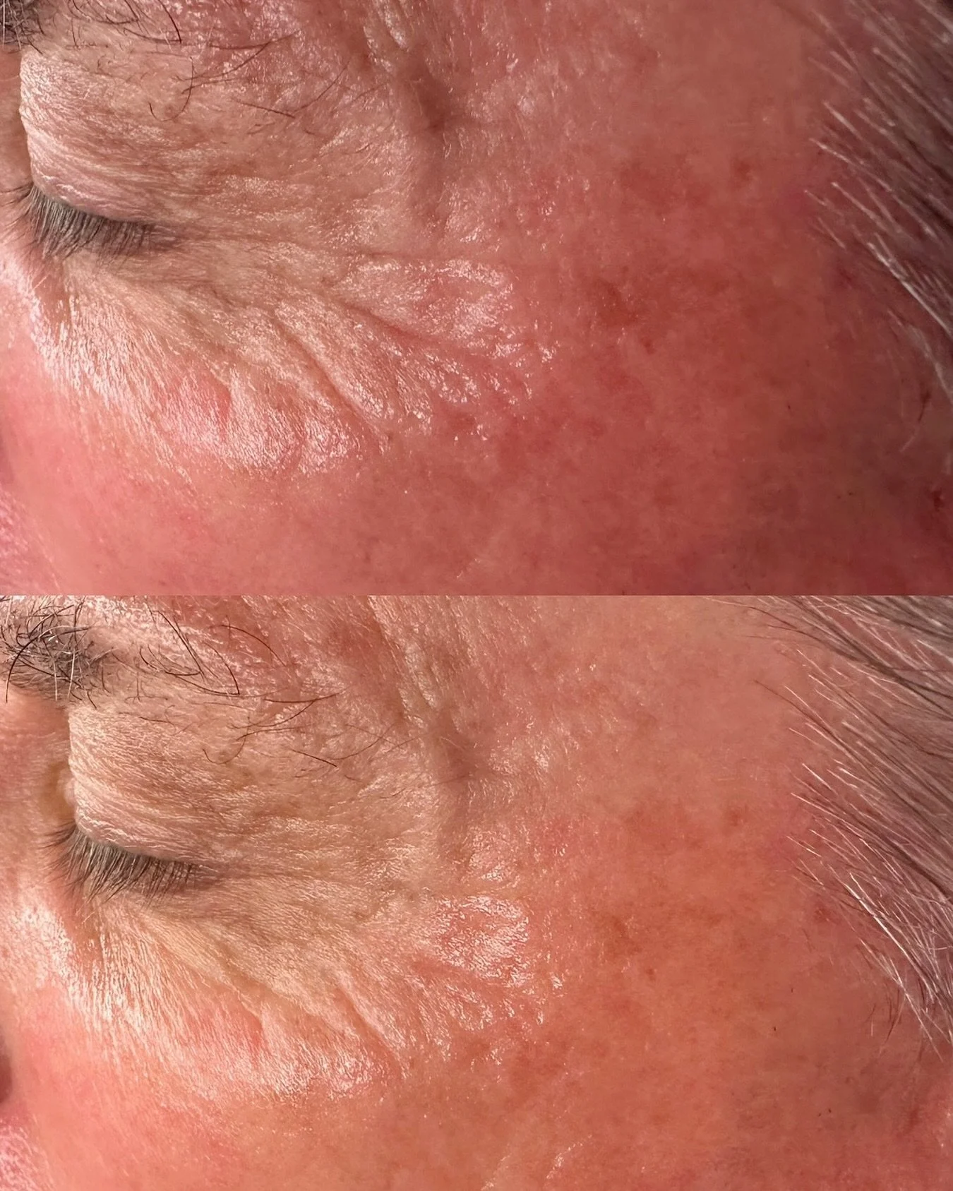 ✨ Hydrafacial&reg; results ✨
Look at the difference in fine lines and skin texture smoother, more hydrated, and refreshed in just one treatment.

This is why Hydrafacial is one of my top services it delivers instant glow + long term skin health