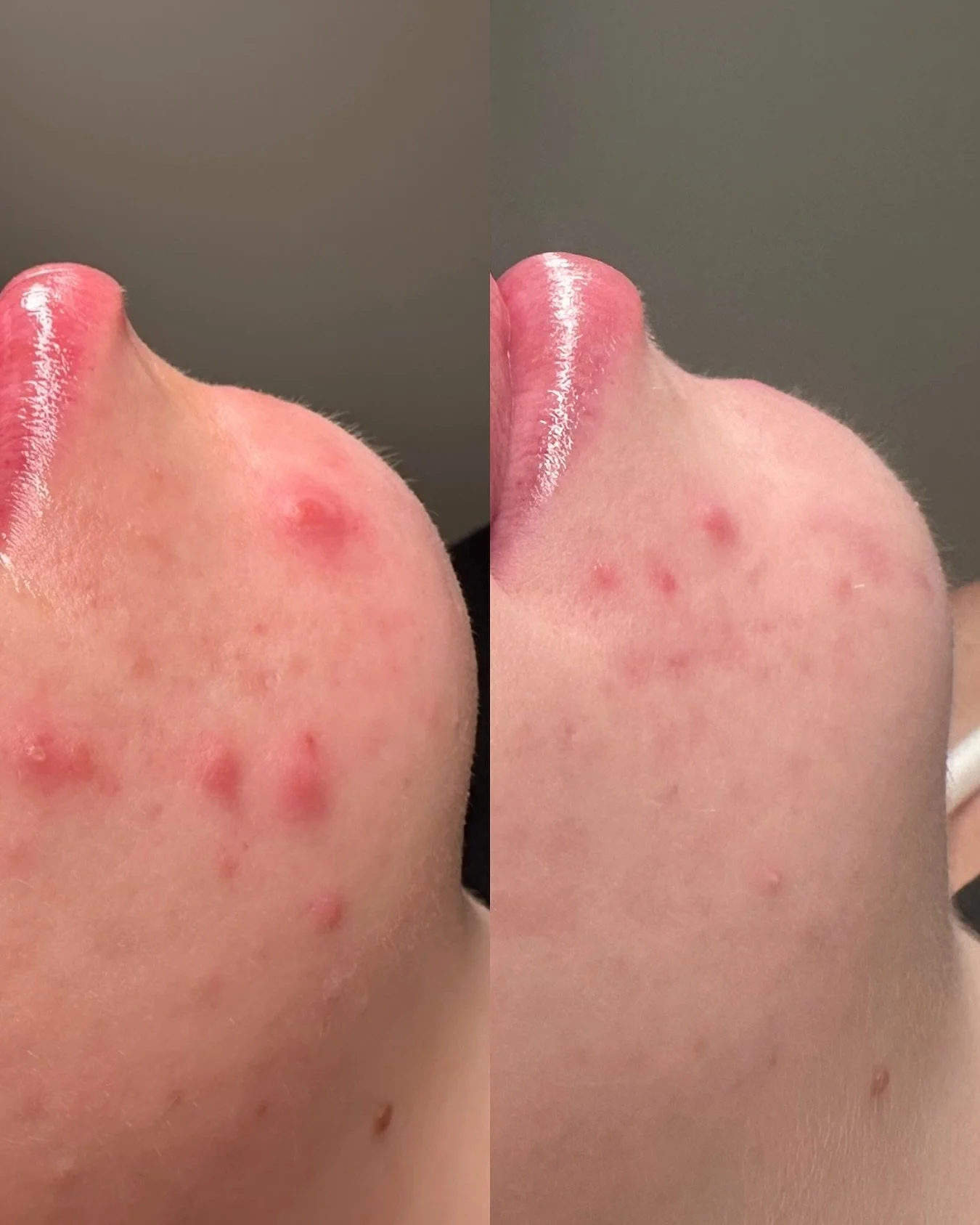 ✨ Real Skin &bull; Real Results ✨
This client started with BioRePeel + Home care products to target active breakouts. Now that the skin is calmer, we&rsquo;re focusing on post inflammatory marks + overall skin texture 

Clear, healthy skin doesn&rsqu