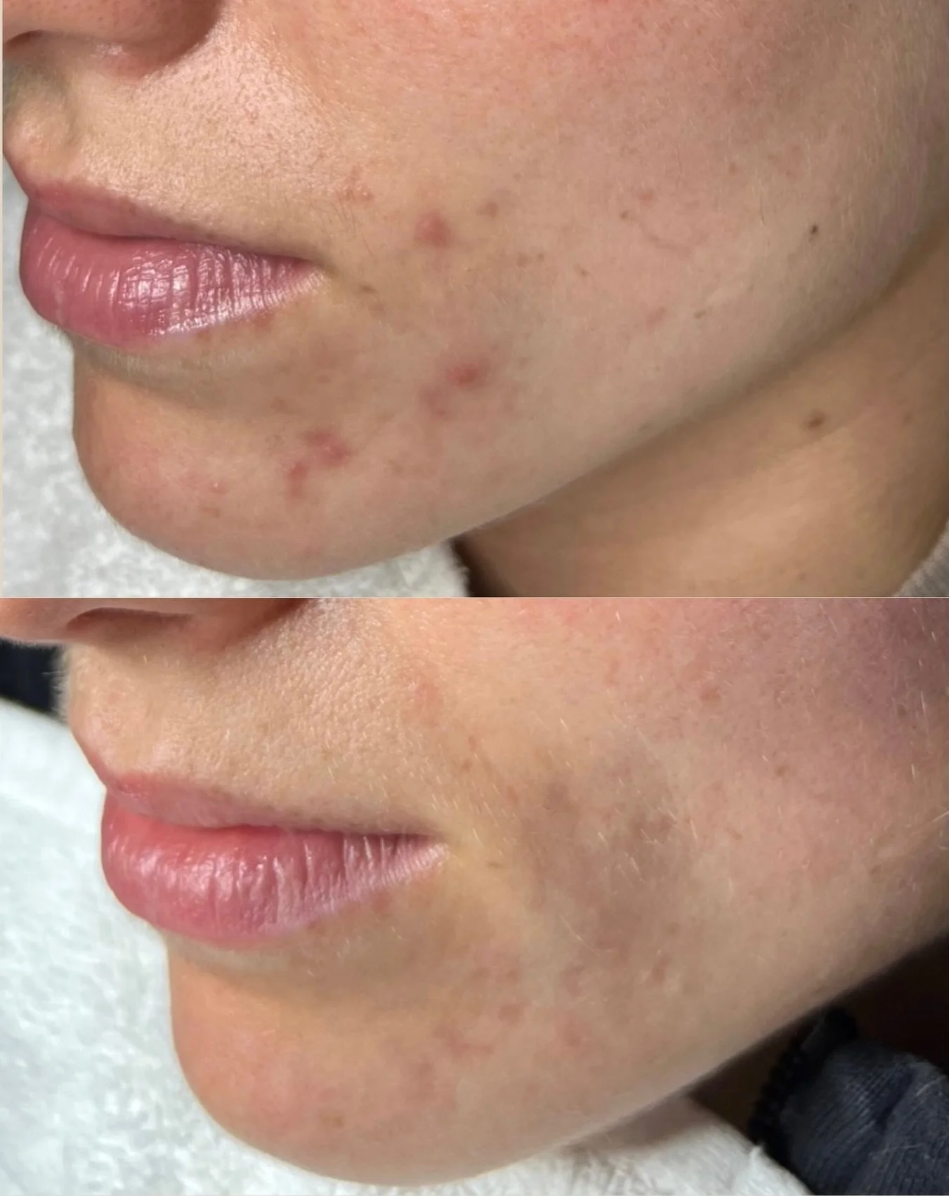 These are real Face Reality Acne Bootcamp results! 😍
Just look at this transformation redness calmed, inflammation down, and the skin&rsquo;s natural glow coming back.

This is what consistent professional guidance + customized homecare can do.