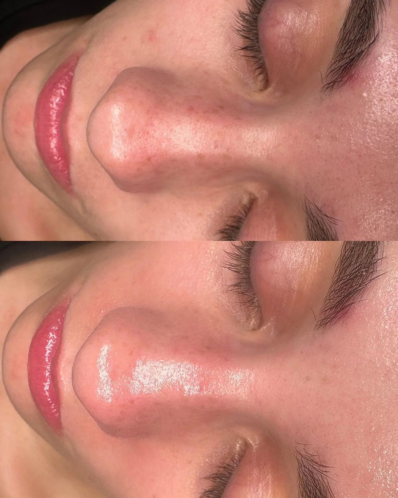 💧 HydraFacial Extraction Process Explained

Unlike traditional extractions that involve manual pressure, the HydraFacial uses a gentle, vacuum like vortex technology to deeply cleanse pores without pain or redness.

	1.	Active serums loosen debris:
