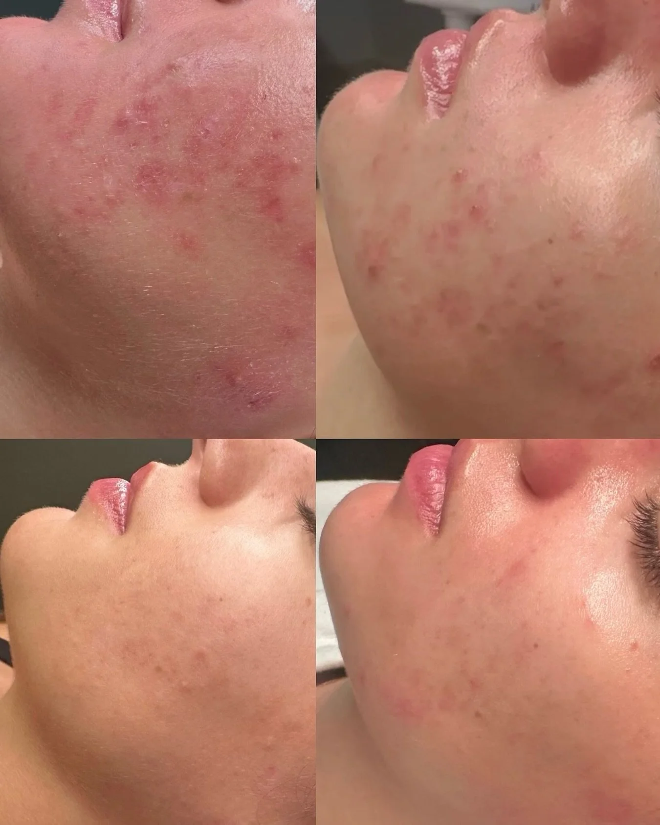 Acne doesn&rsquo;t disappear overnight. Consistency, patience, and the right routine make all the difference ✨

( you can see her glow come back 🥹 )