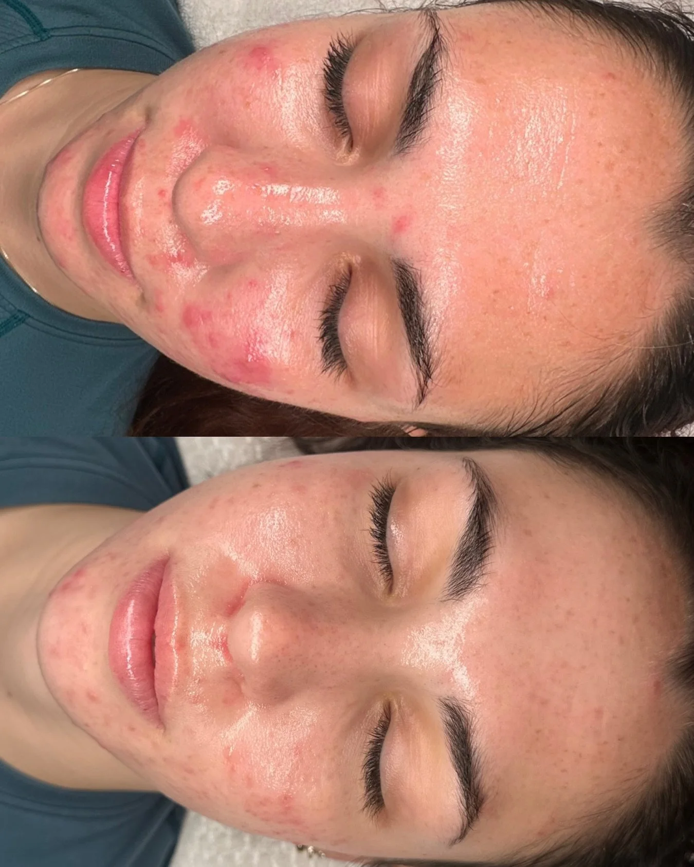 Skin in progress and that&rsquo;s exactly how we like it. ✨

This before &amp; after shows active acne beginning to calm, inflammation reducing, and the skin barrier starting to heal we have been doing BioRePeel treatments.

She is also on a fully cu