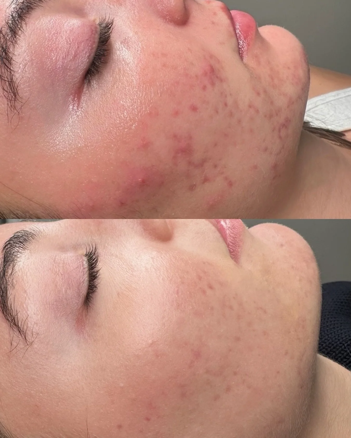 Inflamed acne. Congestion. Post inflammatory redness.

This is exactly what Acne Bootcamp was designed for.

With customized homecare + structured treatments, we reduce inflammation, clear breakouts, and rebuild the skin barrier the right way.

Does 