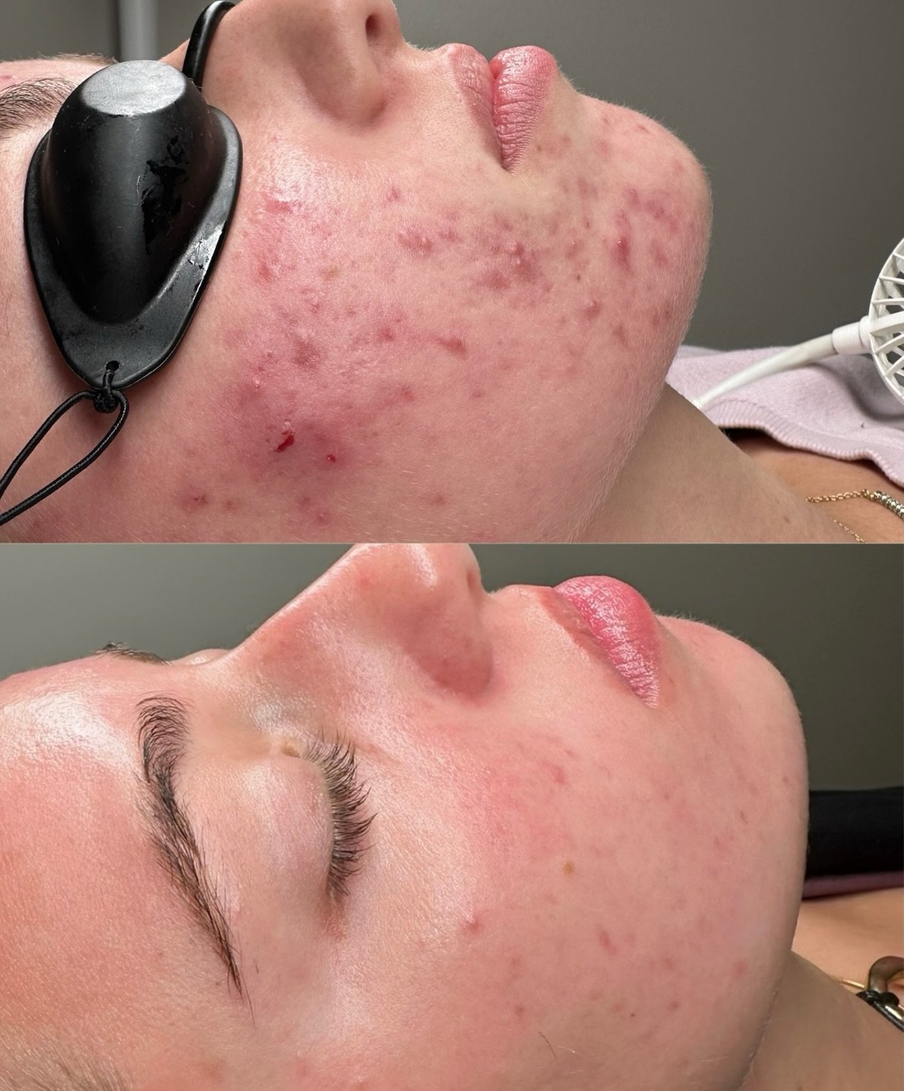 If your acne looks like the top photo&hellip; don&rsquo;t scroll.

This is not &ldquo;just hormonal.&rdquo;
This is not &ldquo;something you have to live with.&rdquo;
And no, you don&rsquo;t need to try 10 random products from TikTok.

With the right