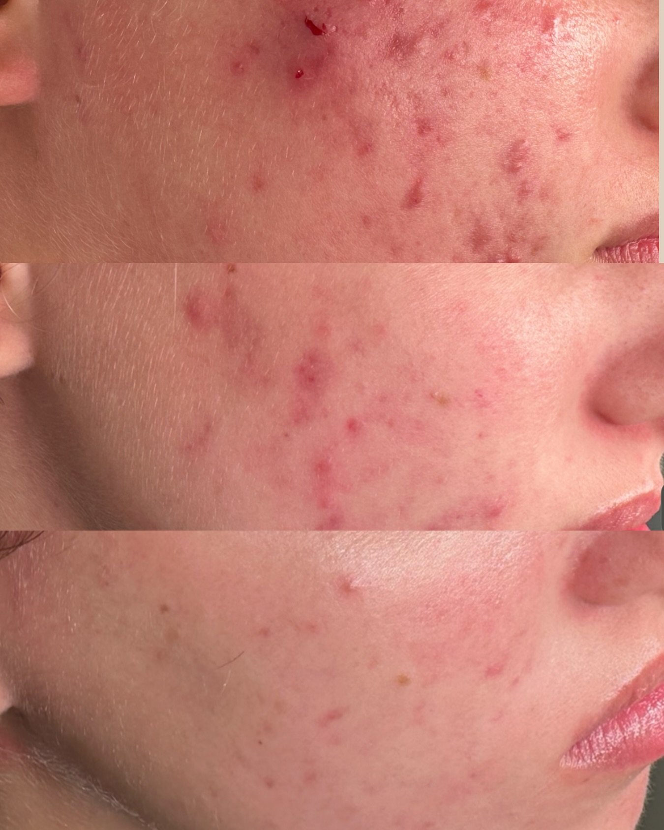 This is what happens when you stop guessing.

Targeted acne treatments.
Customized homecare.
Zero pore clogging products.

Breakouts don&rsquo;t stand a chance when we treat them correctly 🧐✨

Ready for clear skin? DM me 🤍