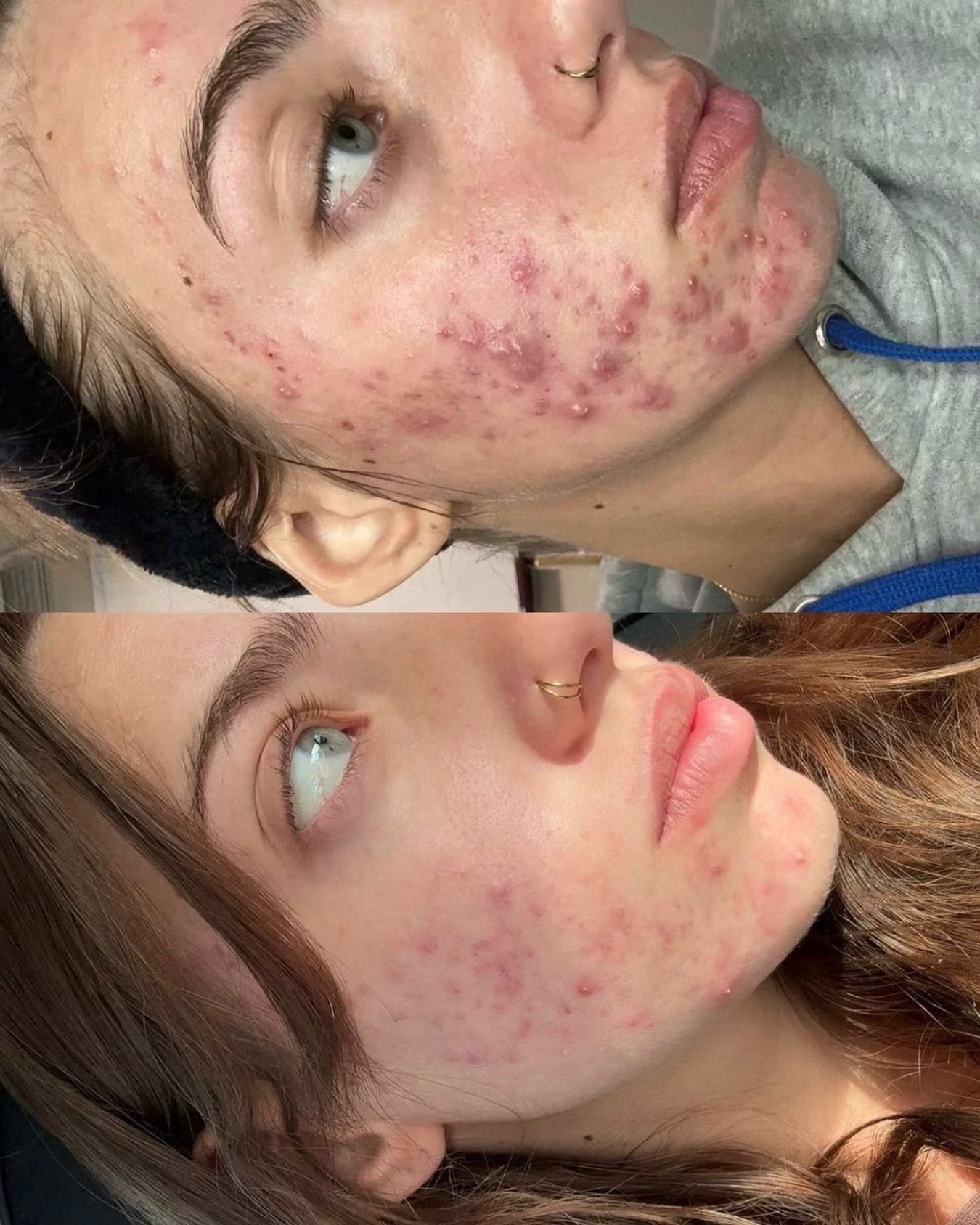 This transformation is only 19 days apart&hellip; just 2 weeks and 5 days. ✨

And we&rsquo;re not even close to finished yet.

Clear skin doesn&rsquo;t happen from one facial it happens from consistency, the right products, and a customized routine.
