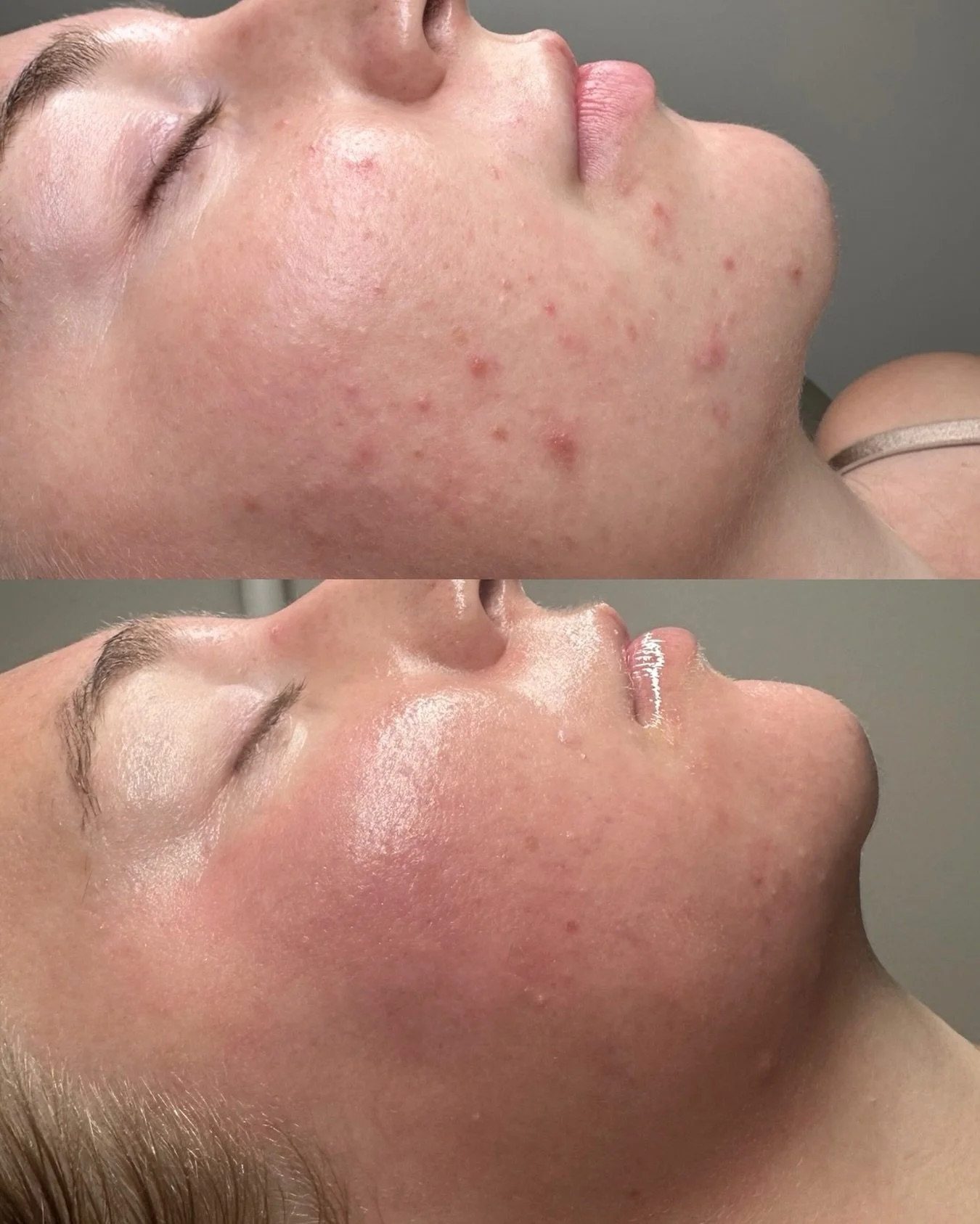 Acne Bootcamp progress ✨
This is after her 3rd bi weekly corrective peel with strict homecare + consistency.

Healing acne is a process not a quick fix.
We are focusing on reducing inflammation, strengthening the barrier, and correcting breakouts saf