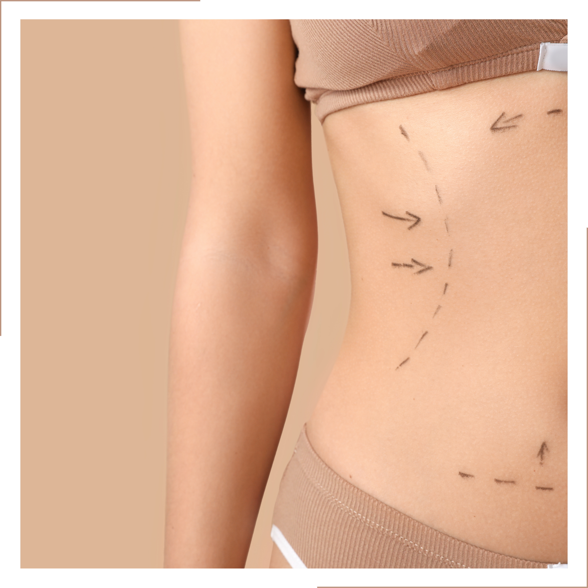 Close-up of a woman with surgical markings on her abdomen, indicating a planned cosmetic procedure, with her arm and beige clothing visible.