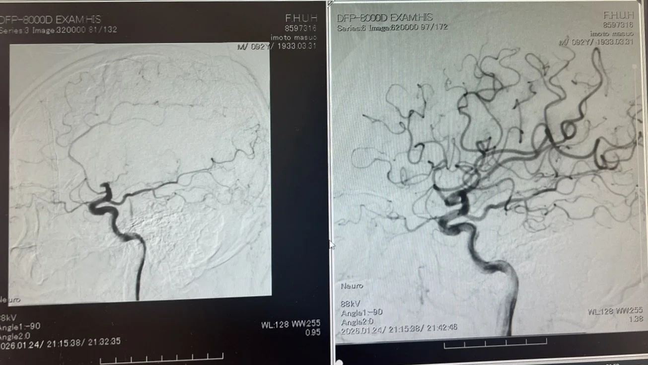 左後頭部の大きな血管が詰まっている（左写真）。血栓を除去して止まっていた血管に血流が戻った様子（右写真）。