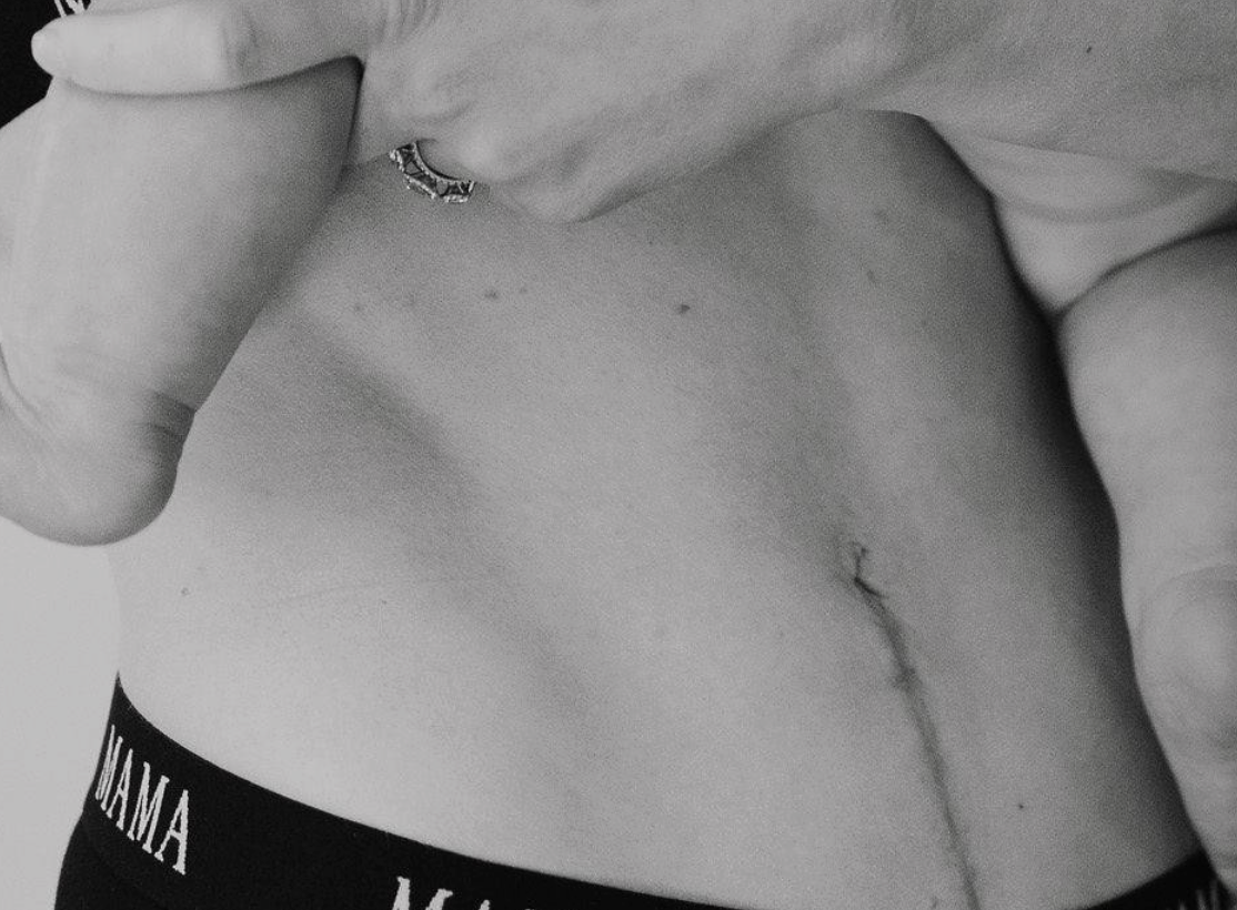 C-Section Recovery Tips No One Talks About (And Wish They Had)