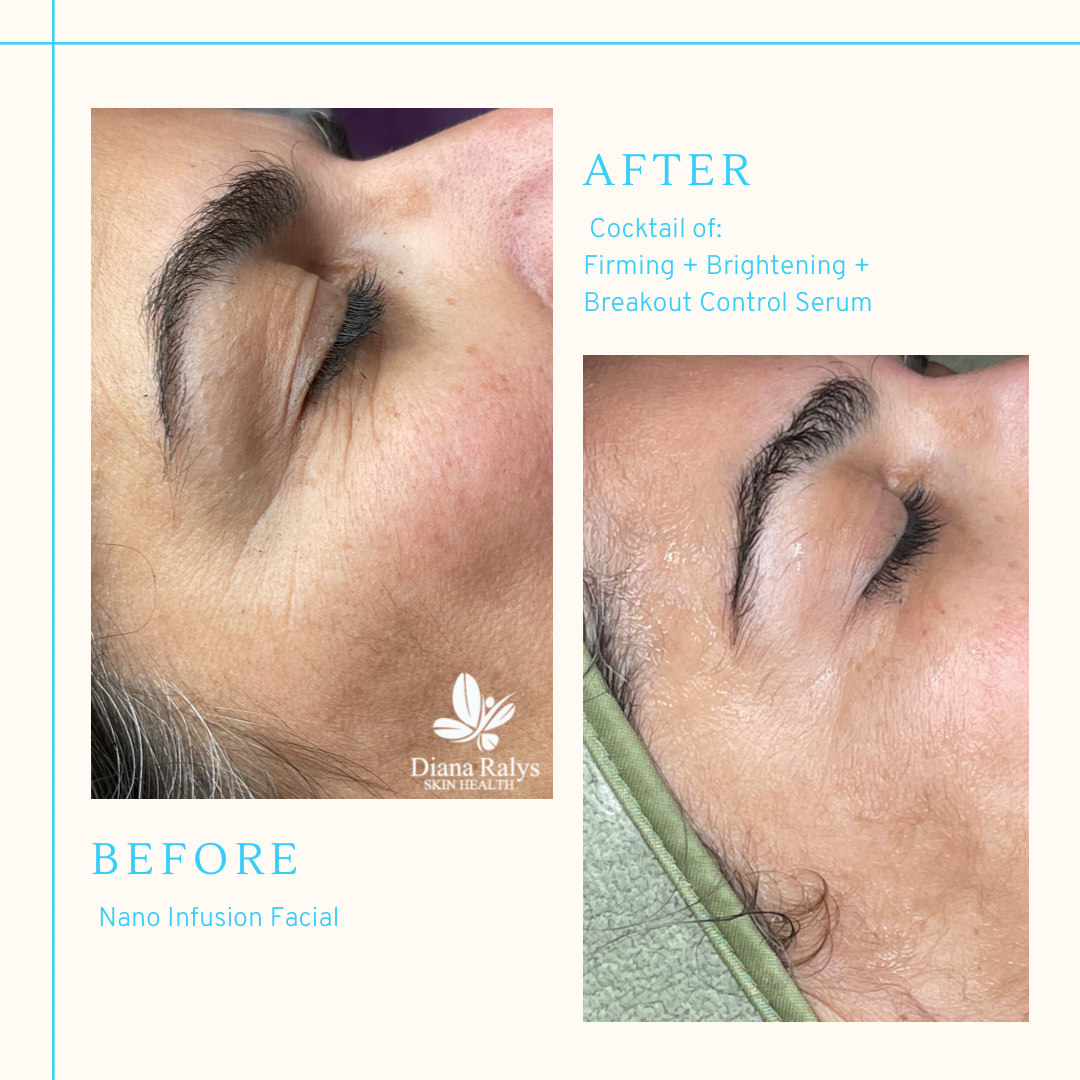 nano infusion facial before and after. plumping skin, reduce fine lines and wrinkles, antiaging facial in santa monica