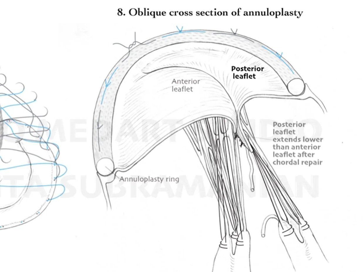SurgicalStepsMitralValveRepair_8.jpg