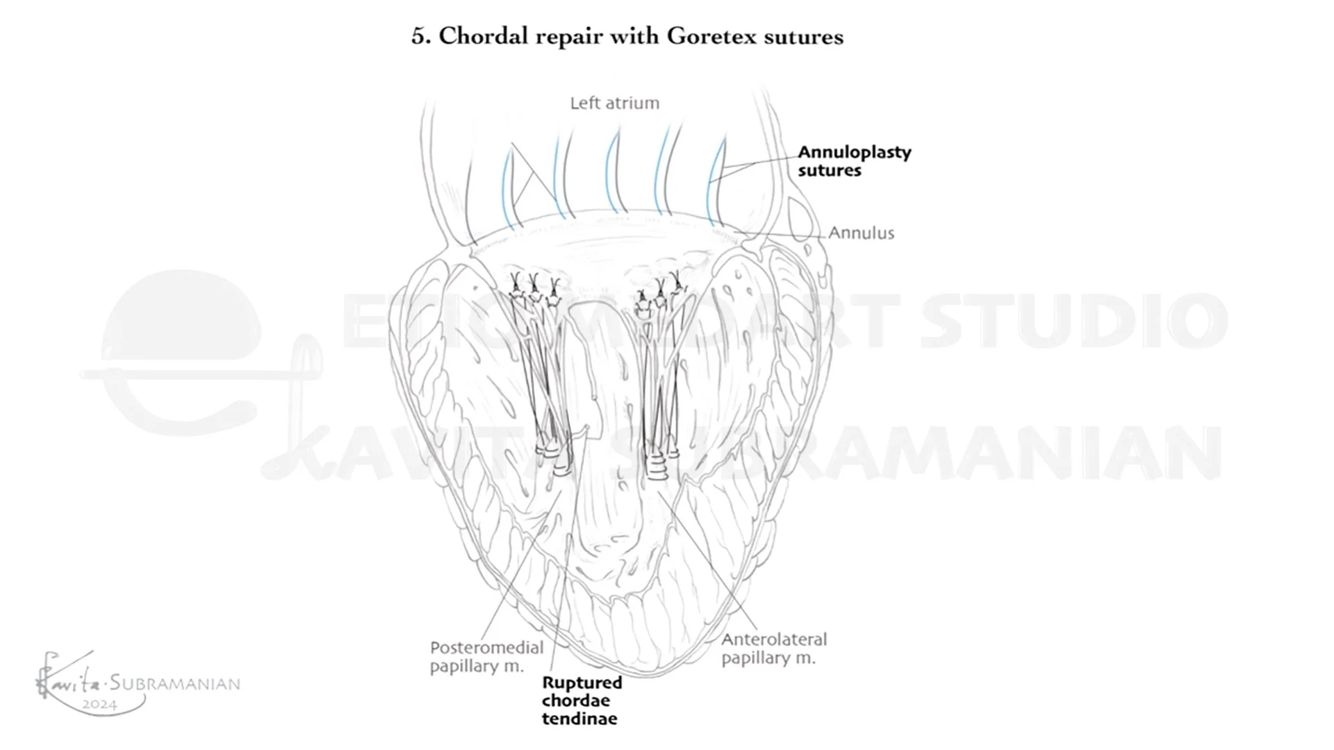 SurgicalStepsMitralValveRepair_5.jpeg