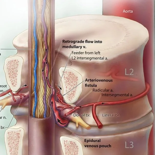 5+Neuroanatomy+AVM+fistula.jpg