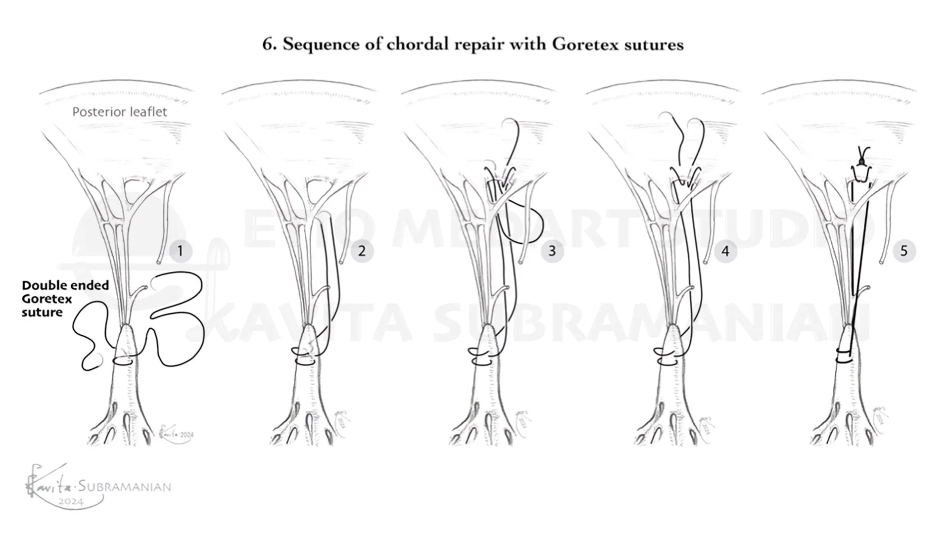 SurgicalStepsMitralValveRepair_6.jpeg