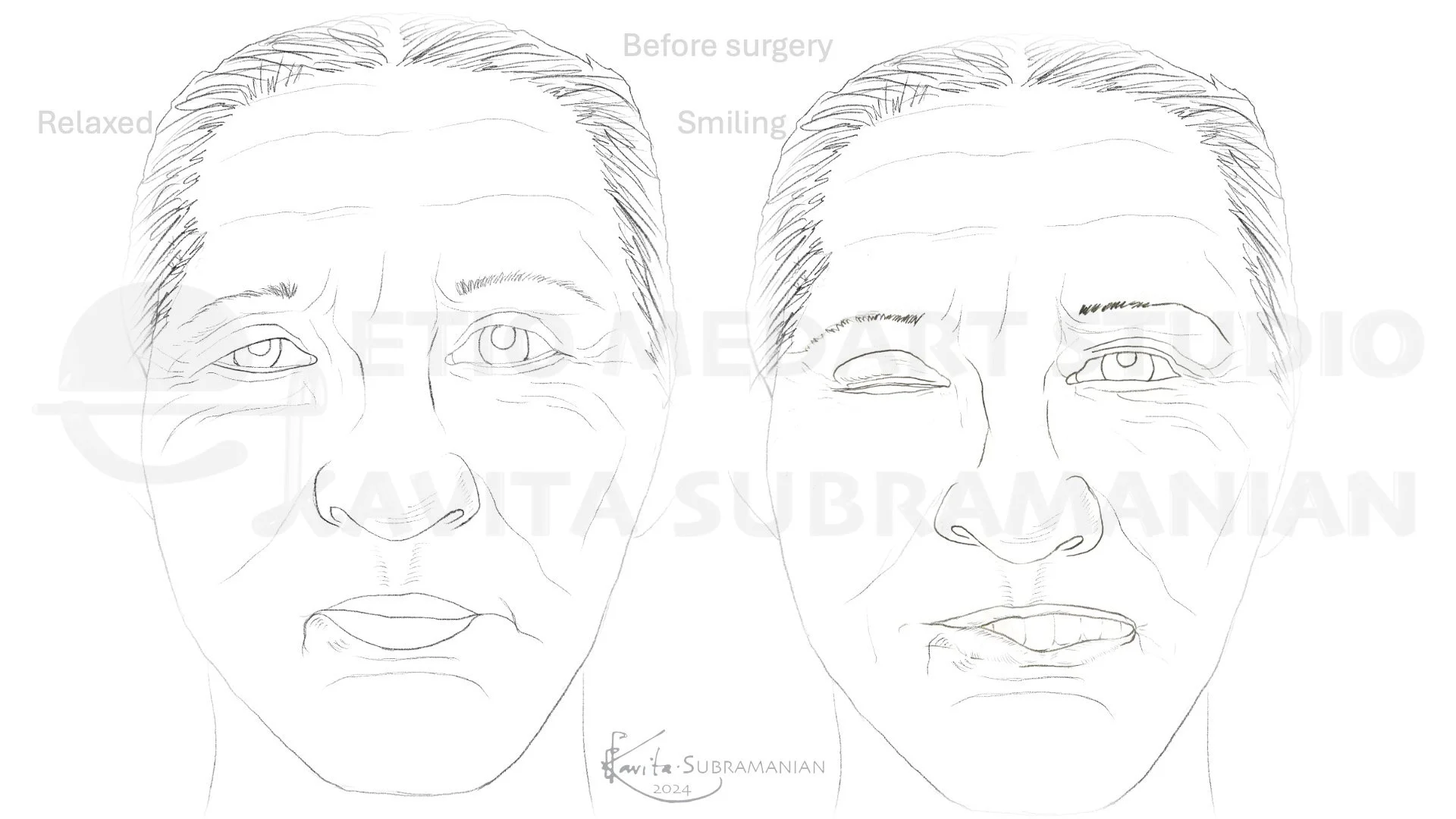 SurgicalStepsBrowPtosisCorrection_1.jpeg