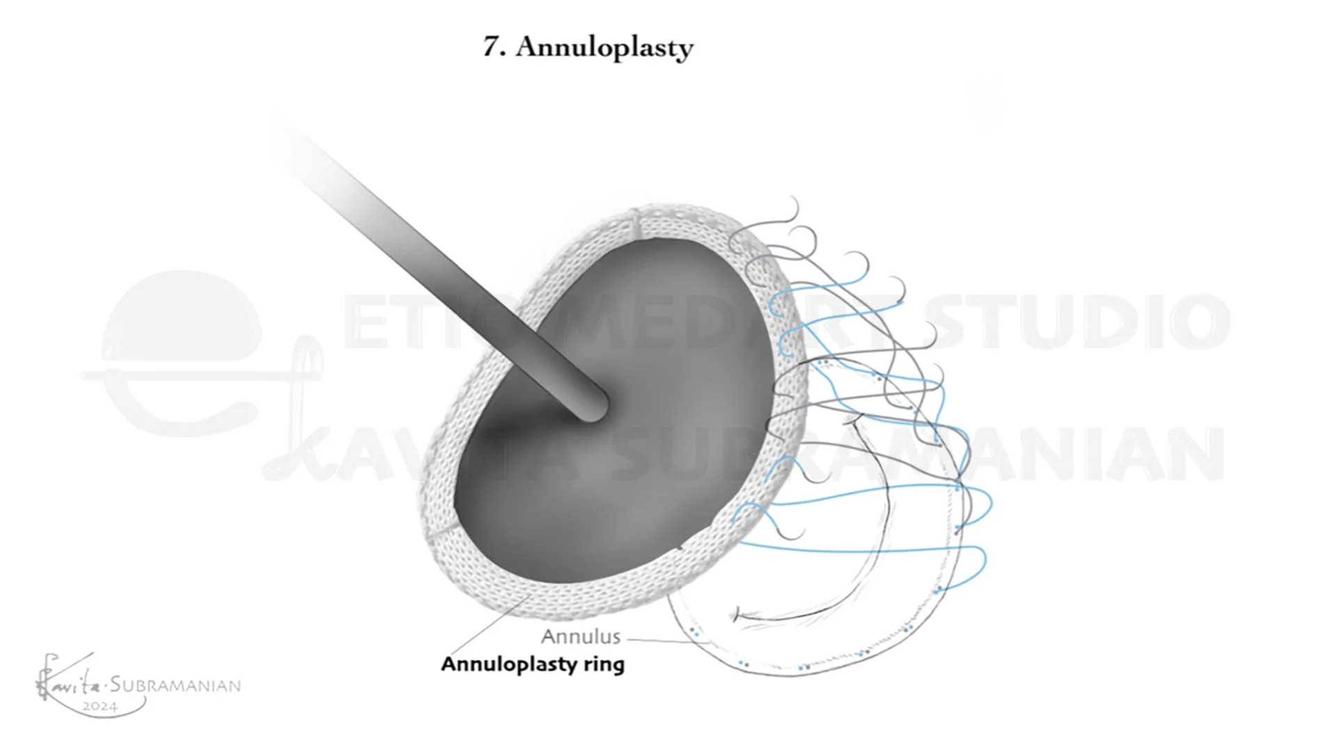 SurgicalStepsMitralValveRepair_7.jpeg