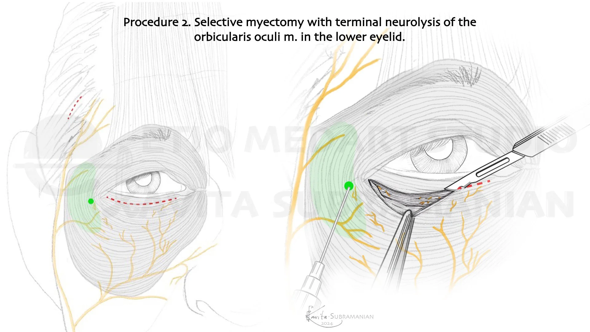 SurgicalStepsBrowPtosisCorrection_5.jpeg