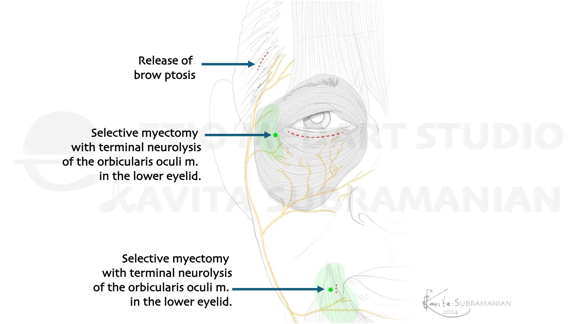 SurgicalStepsBrowPtosisCorrection_2.jpeg