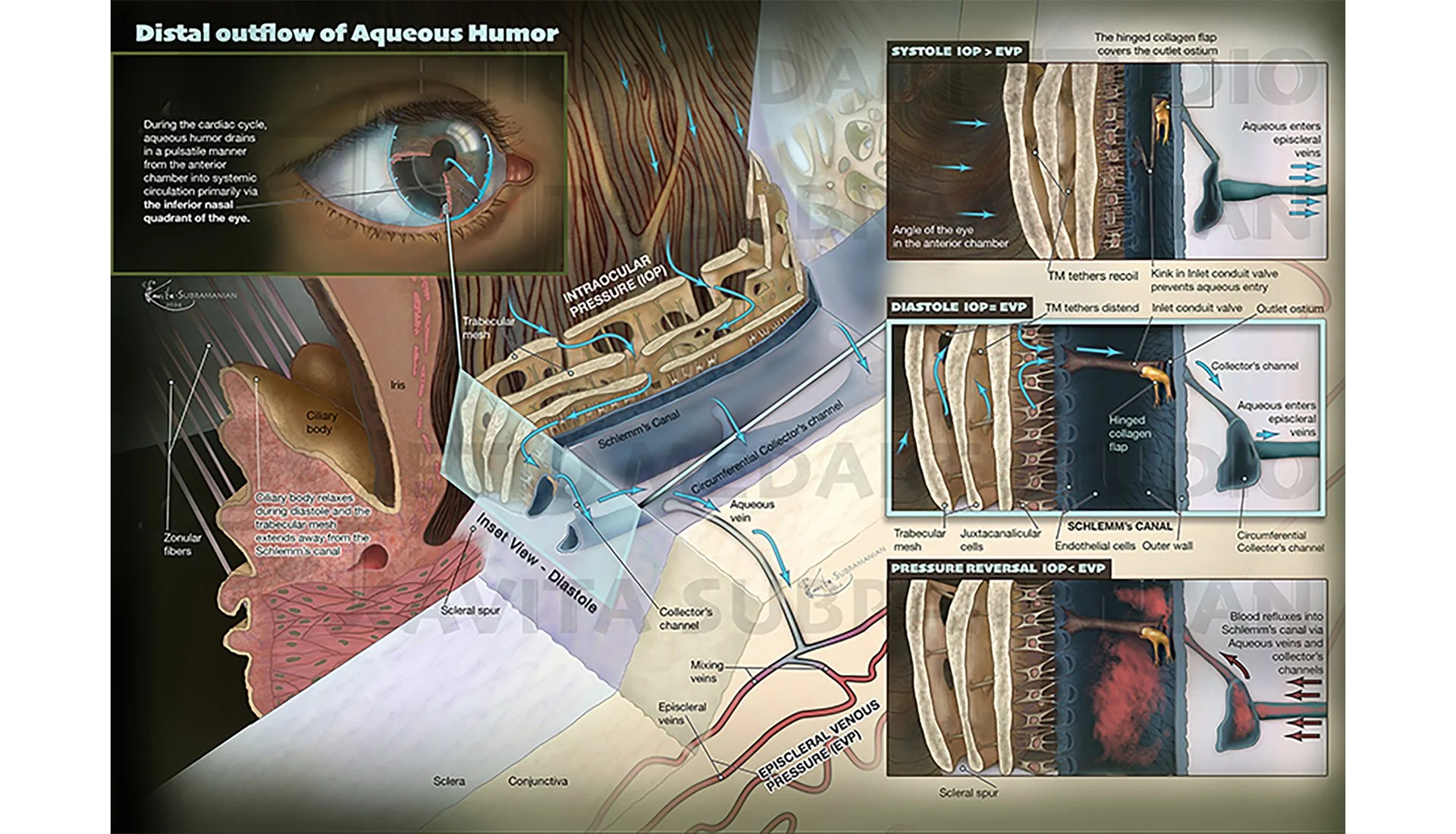 006 Anatomical Glaucoma WM.jpg