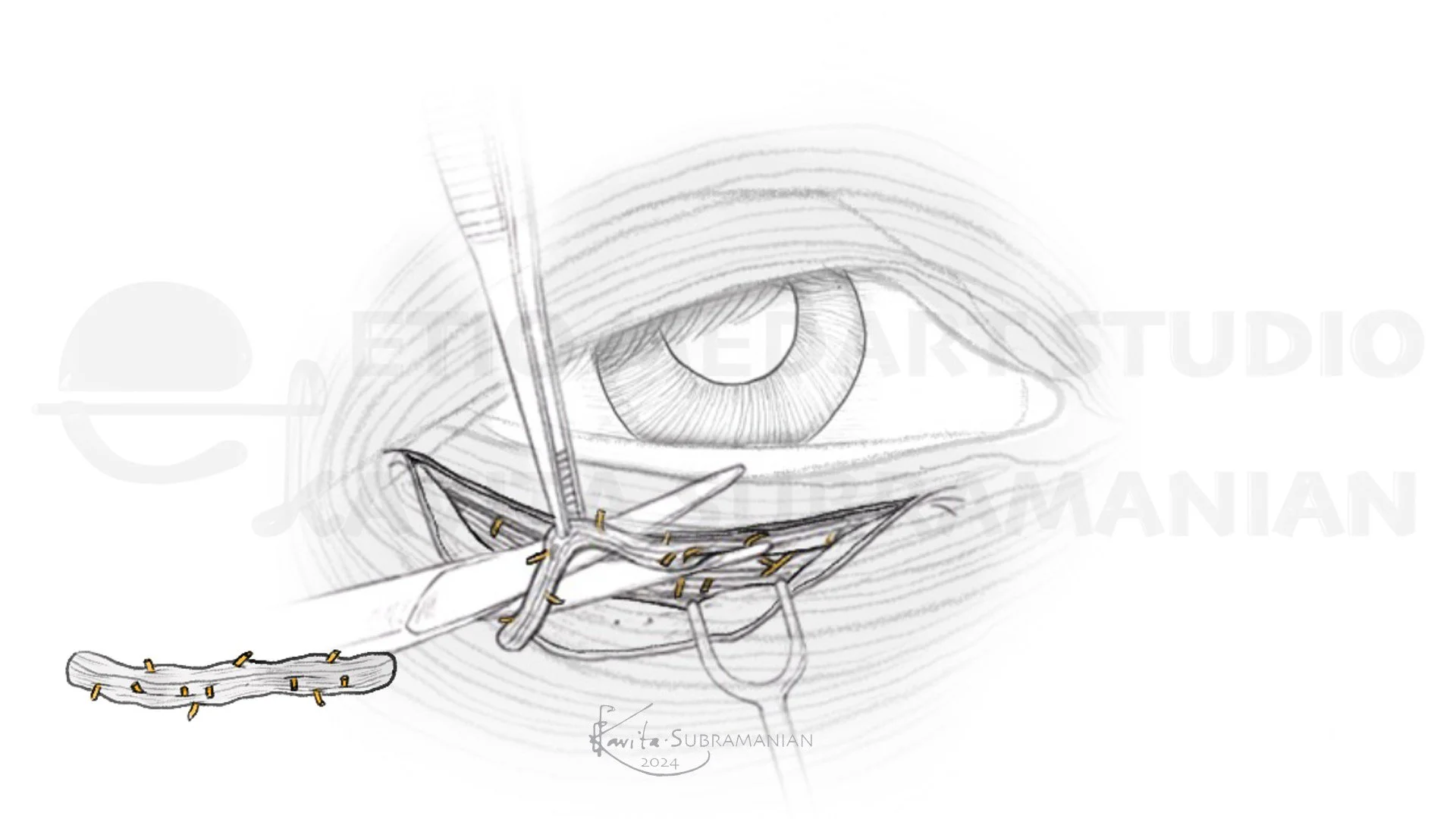 SurgicalStepsBrowPtosisCorrection_6.jpeg