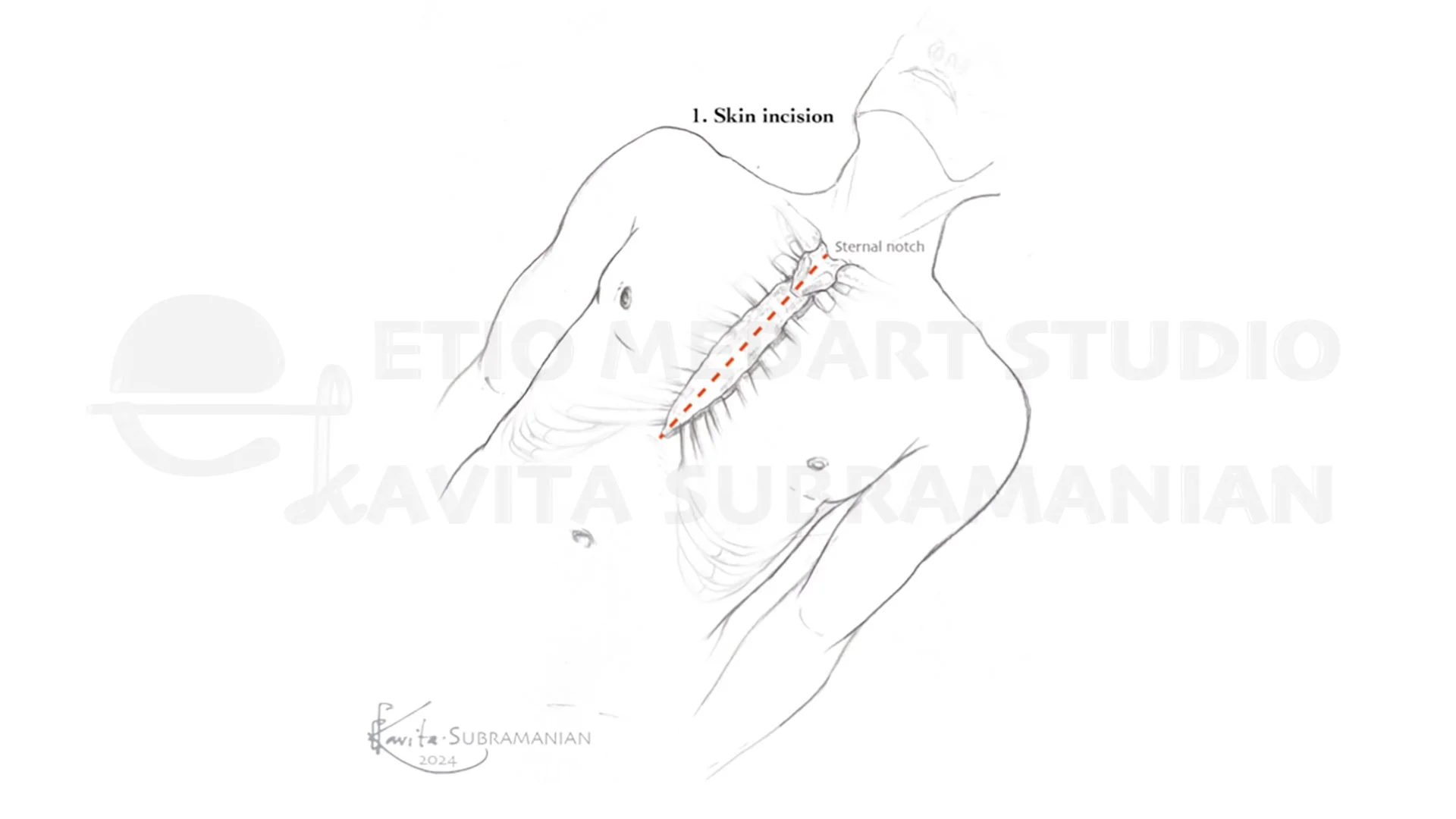 SurgicalStepsMitralValveRepair_1.jpeg
