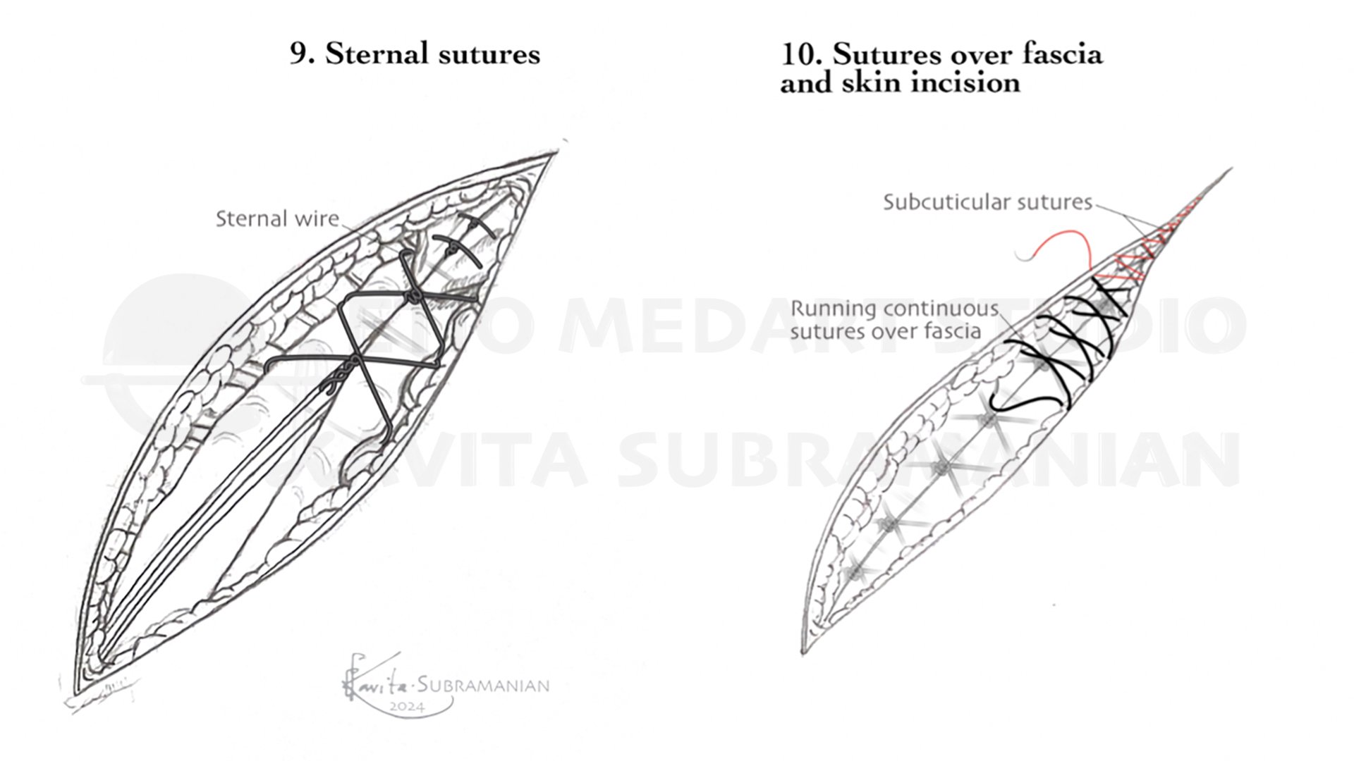 SurgicalStepsMitralValveRepair_9.jpeg