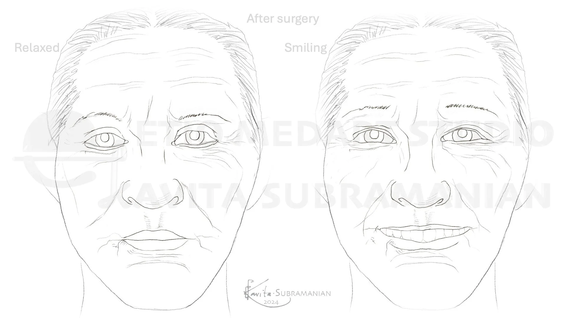SurgicalStepsBrowPtosisCorrection_8.jpeg