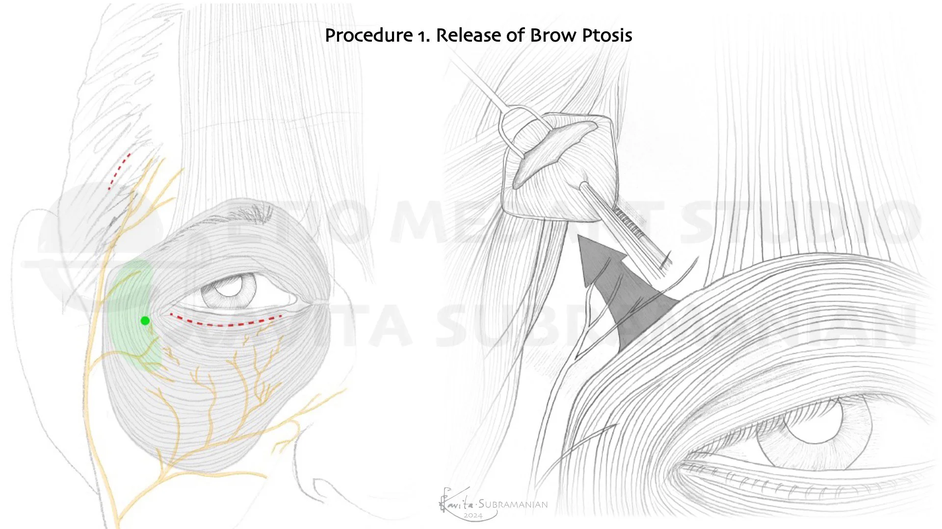 SurgicalStepsBrowPtosisCorrection_3.jpeg
