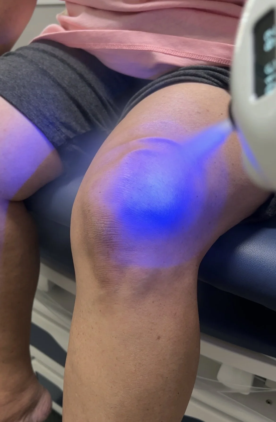 Close-up of a person receiving CO2 cryotherapy from the SubZero cryotherapy device.