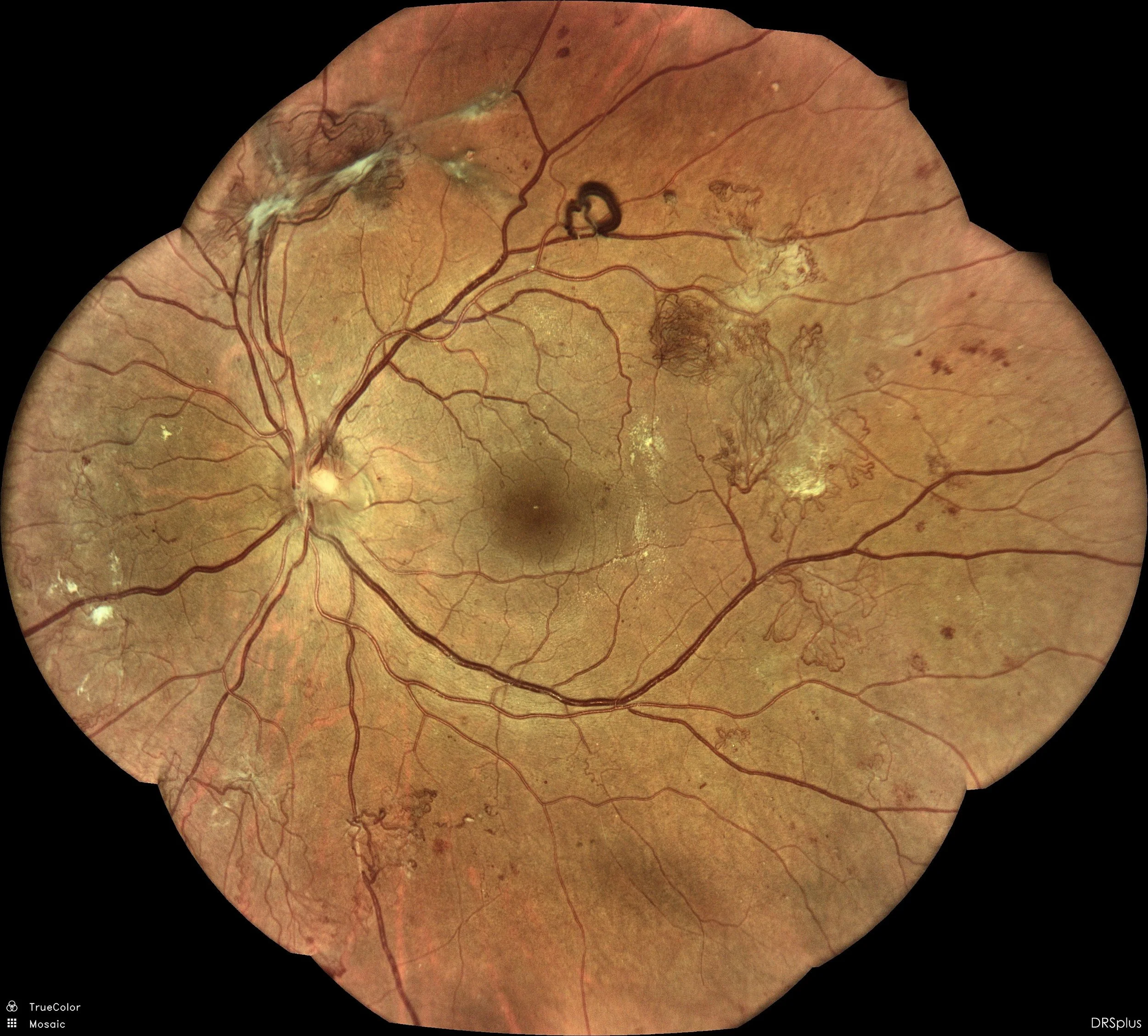 Severe Proliferative Diabetic Retinopathy