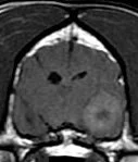 Parietal Mass MRI cropped.jpeg