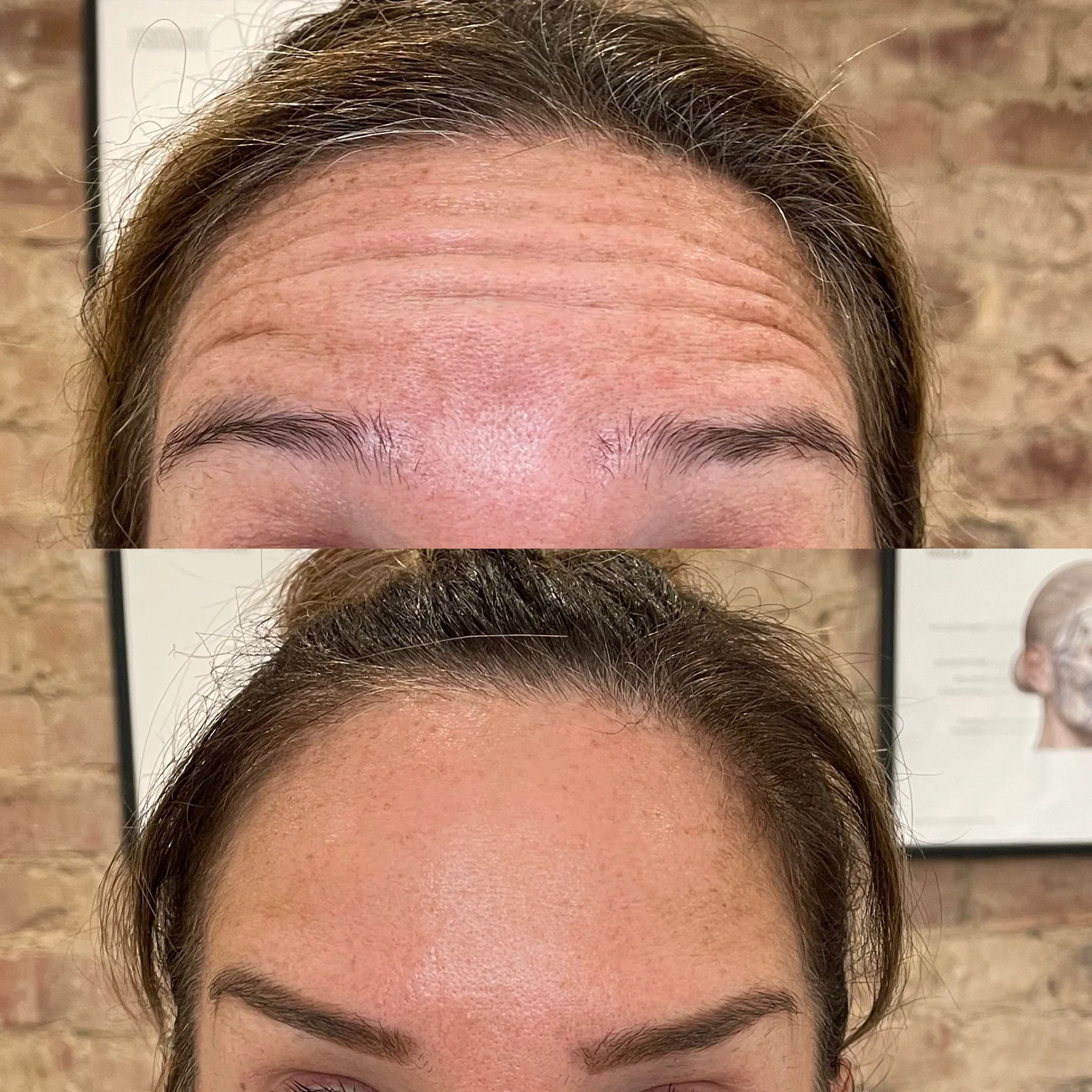 Antiwrinkle forehead.jpeg
