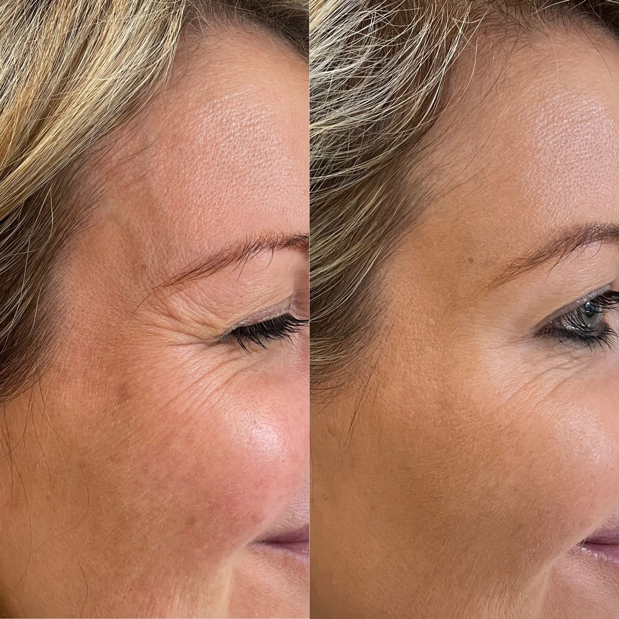 Antiwrinklecrowsperioral.jpeg